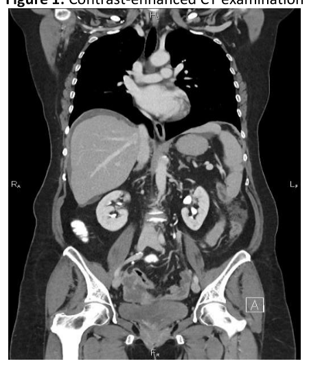 Contrast-enhanced coronal CT examination of the abdomen and pelvis