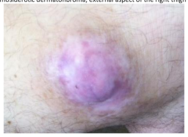 Hemosiderotic dermatofibroma, external aspect of the right thigh's distal third