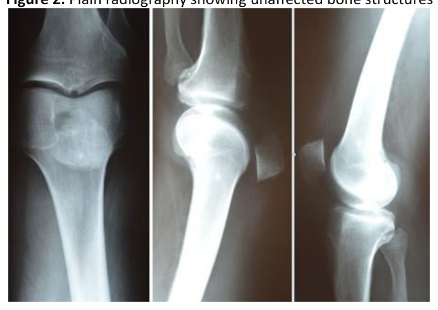 Plain radiography showing unaffected bone structures