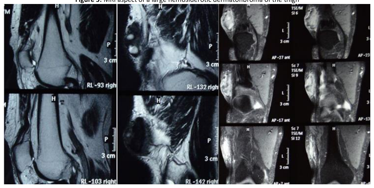 MRI aspect of a large hemosiderotic dermatofibroma of the thigh