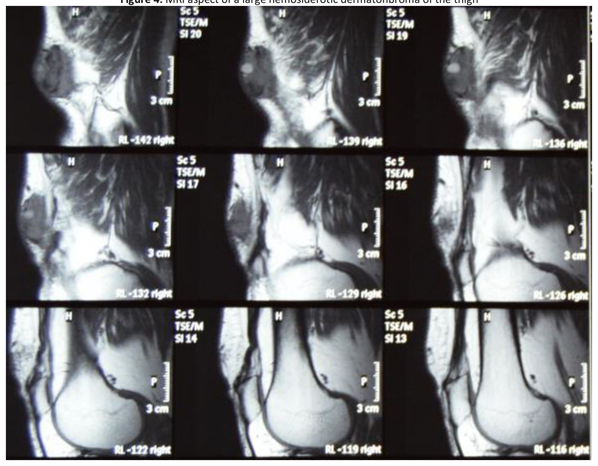 MRI aspect of a large hemosiderotic dermatofibroma of the thigh