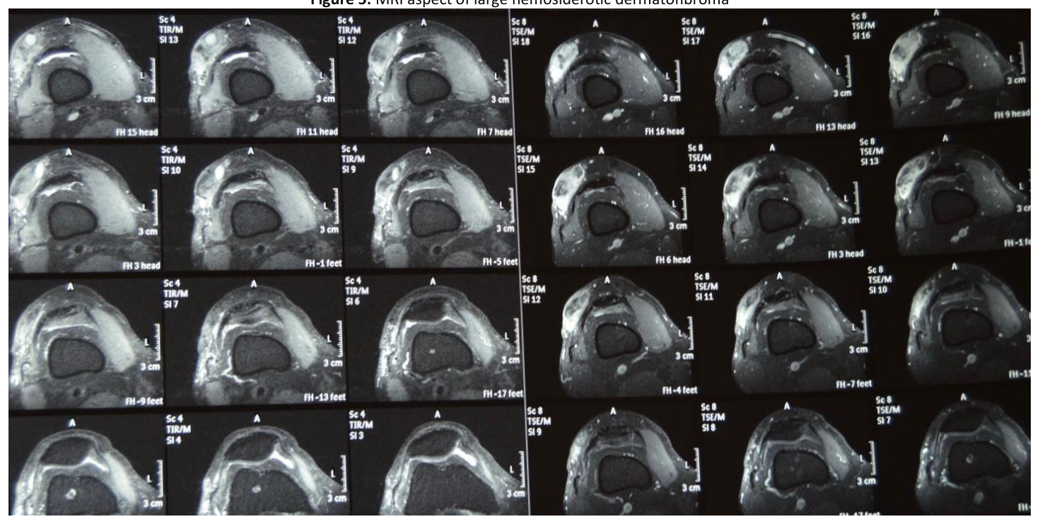 MRI aspect of large hemosiderotic dermatofibroma