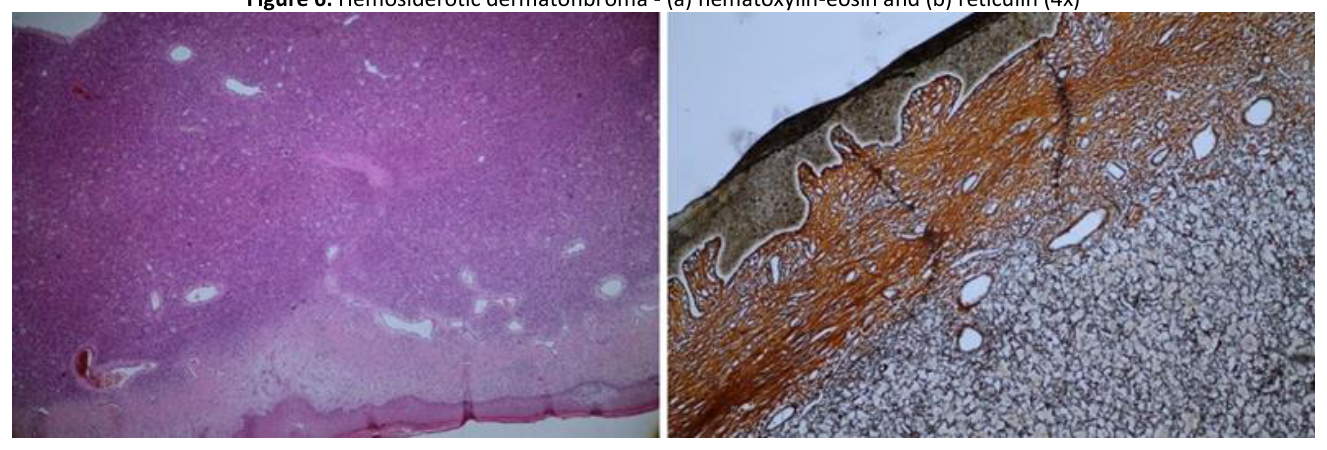 Hemosiderotic dermatofibroma - (a) hematoxylin-eosin and (b) reticulin (4x)