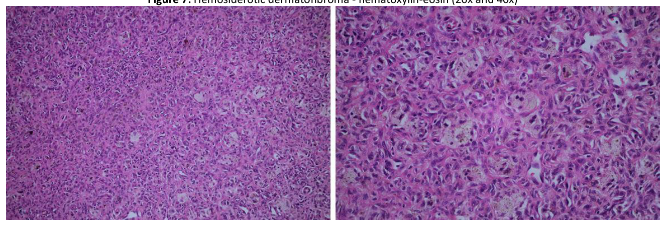 Hemosiderotic dermatofibroma - hematoxylin-eosin (20x and 40x)