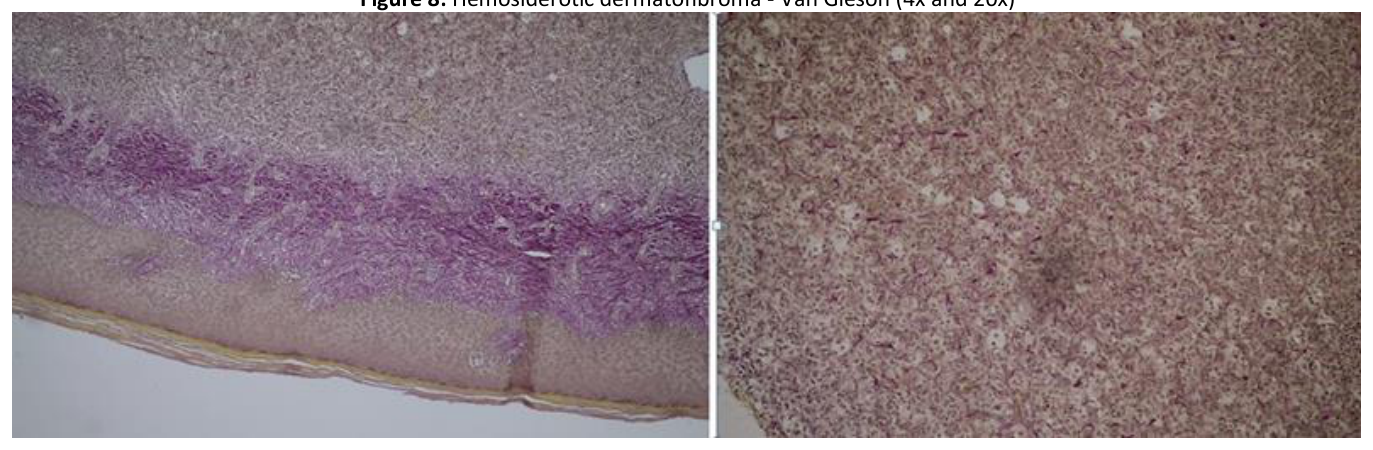 Hemosiderotic dermatofibroma - Van Gieson (4x and 20x)