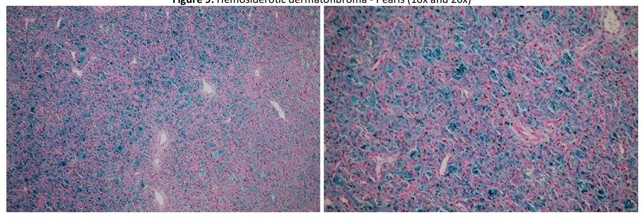 Hemosiderotic dermatofibroma - Pearls (10x and 20x)