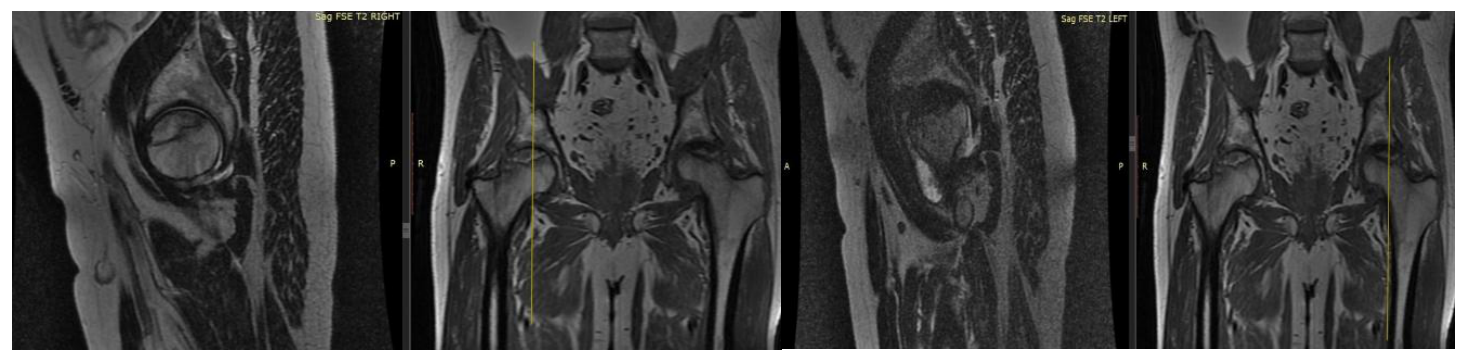 MRI of the right hip and MRI of the left hip