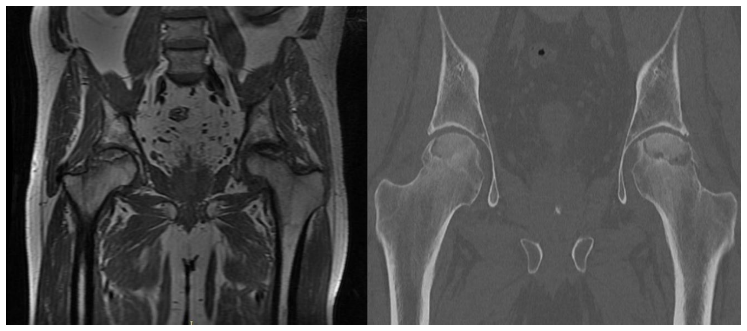 MRI of the hip and CT scan of the hip