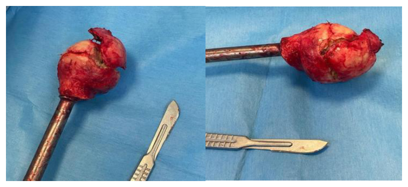 Intraoperative imaging of femoral head