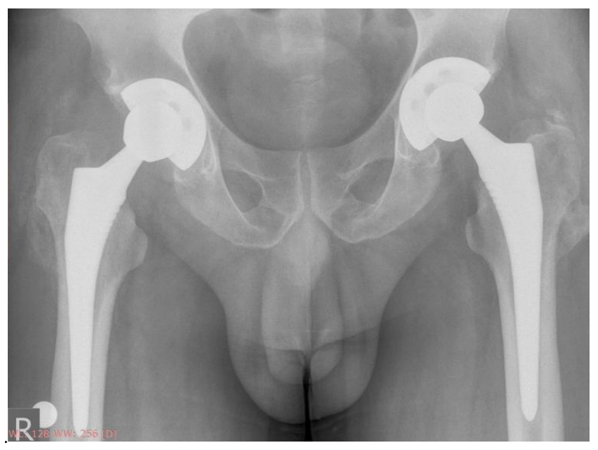Postoperative X-ray of the hip