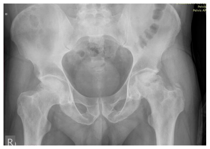Hip X-ray