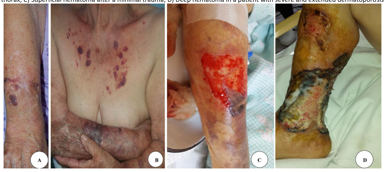 Four clinical photographs of dermatoporosis: forearm lesions, forearm and anterior thorax lesions, a superficial hematoma after minimal trauma, and a deep hematoma with severe extended dermatoporosis