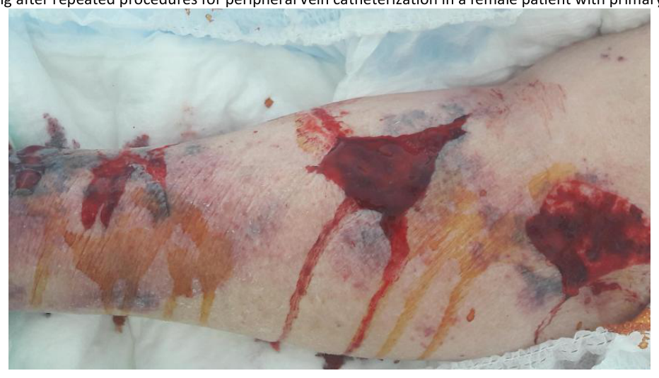 Photograph of a forearm with bleeding lesions after repeated peripheral vein catheterization in a patient with primary dermatoporosis