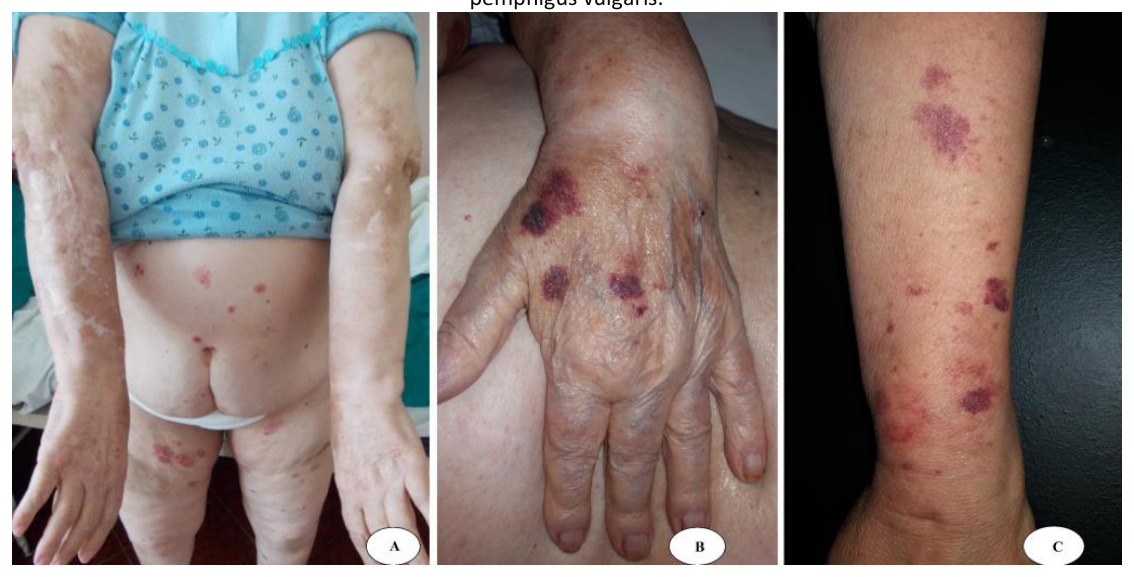 Three clinical photographs of secondary dermatoporosis in patients treated with prednisone for bullous pemphigoid and pemphigus vulgaris, showing lesions on the arms, torso, hand and forearm