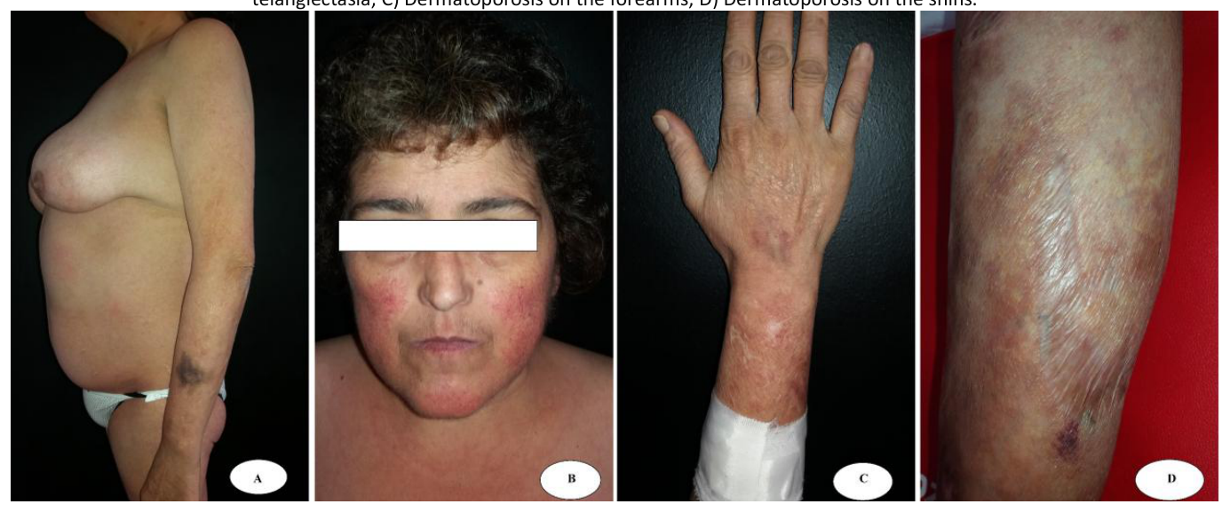 Four clinical photographs of secondary dermatoporosis in a patient with a secreting cortisol tumor, showing Cushing syndrome body habitus, facial telangiectasia, and forearm and shin lesions