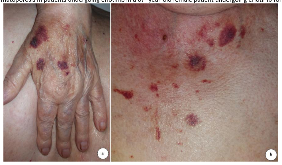 Two clinical photographs of dermatoporosis lesions on the hand and chest of a patient undergoing erlotinib for lung cancer
