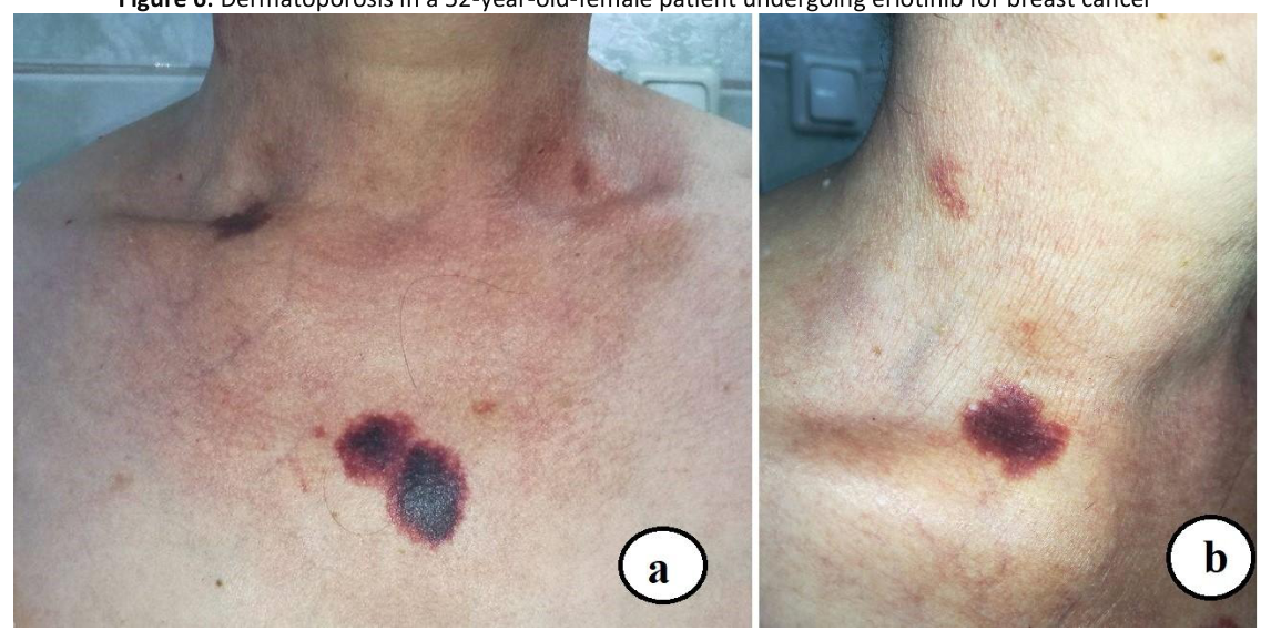 Two clinical photographs of dermatoporosis lesions on the neck and chest of a patient undergoing erlotinib for breast cancer