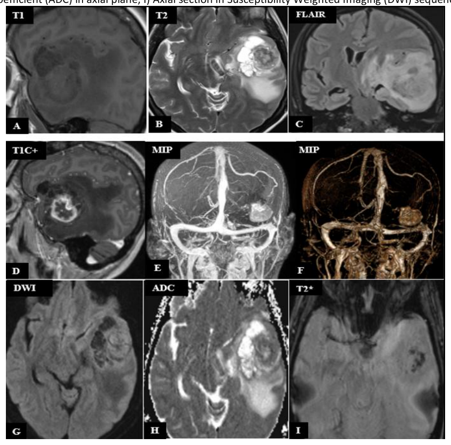 MRI images demonstrating a gliosarcoma with typical localization in the left temporal lobe – A) Sagittal section in T1-weighted imaging; B) Axial section in T2-weighted imaging; C) Coronal section in FLAIR sequence; D) Sagittal section in post-contrast T1-weighted imaging; E-F) MIP reconstruction; G) Diffusion-weighted imaging; H) ADC map; I) Susceptibility-related axial section