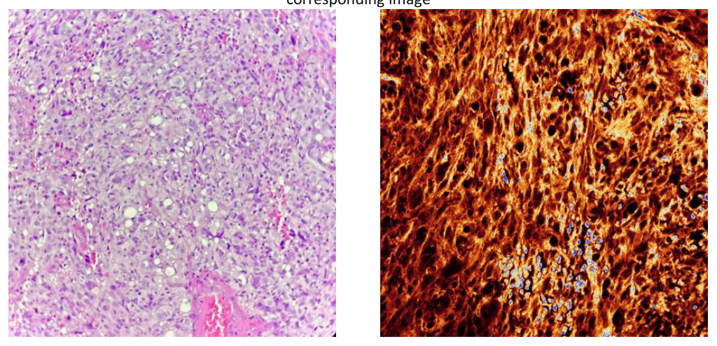 (A) Light microscopy image showing the gliomatous component, with foci of microvascular proliferation. (B) TPEF microscopy showing the corresponding image