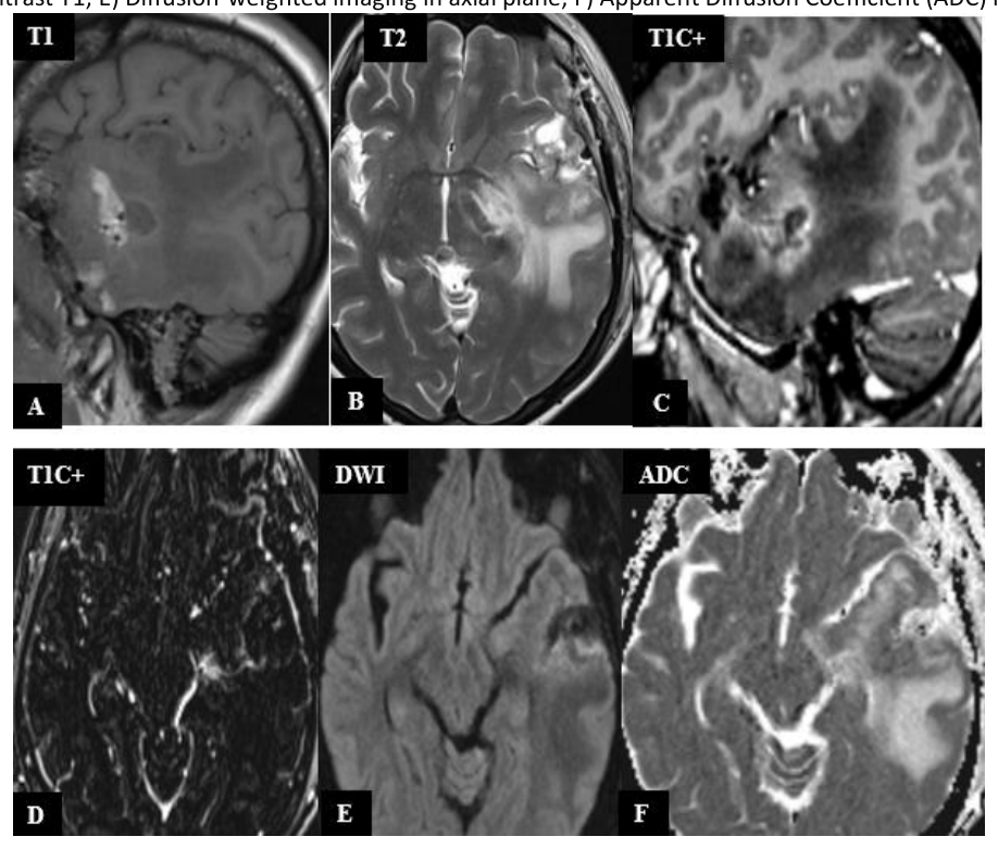 MRI image with postoperative appearance 4 days after surgery - No tumor debris - A) Sagittal section in T1-weighted imaging; B) Axial section in T2-weighted imaging; C) Sagittal section in post-contrast T1-weighted imaging; D) Axial subtraction imaging; E) DWI; F) ADC map
