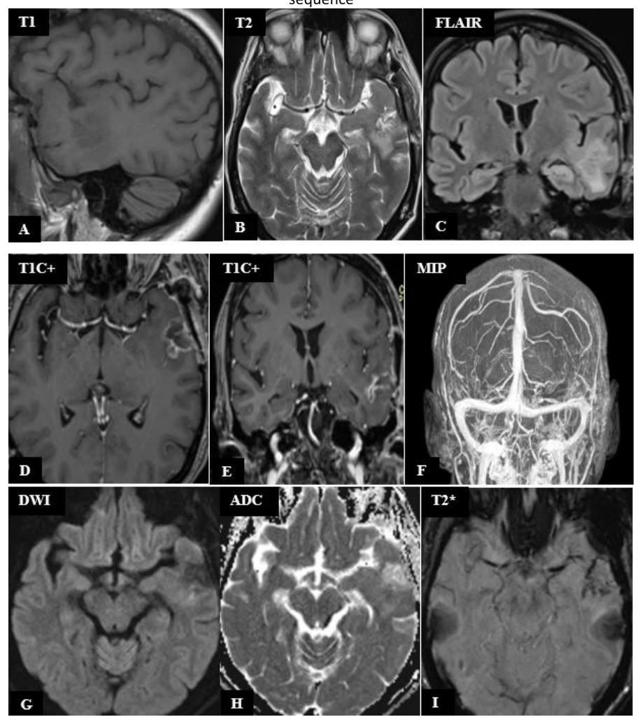MRI images of postoperative appearance 6 days after surgery - No tumor debris present - A) Sagittal section in T1-weighted imaging; B) Axial section in T2-weighted imaging; C) Coronal section in Fluid Attenuated Inversion Recovery (FLAIR) sequence; D) Axial section in post-contrast T1-weighted imaging; E) Coronal section in post-contrast T1-weighted imaging; F) Maximum Intensity Projection (MIP) reconstruction; G) Diffusionweighted imaging in axial plane; H) Apparent Diffusion Coefficient (ADC) in axial plane; I) Axial section in Susceptibility Weighted Imaging (SWI)