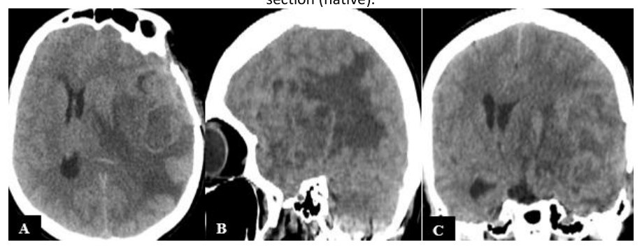 CT images obtained 4 months postoperatively - tumor recurrence - A) Axial section (native); B) Sagittal section (native); C) Coronal section (native)
