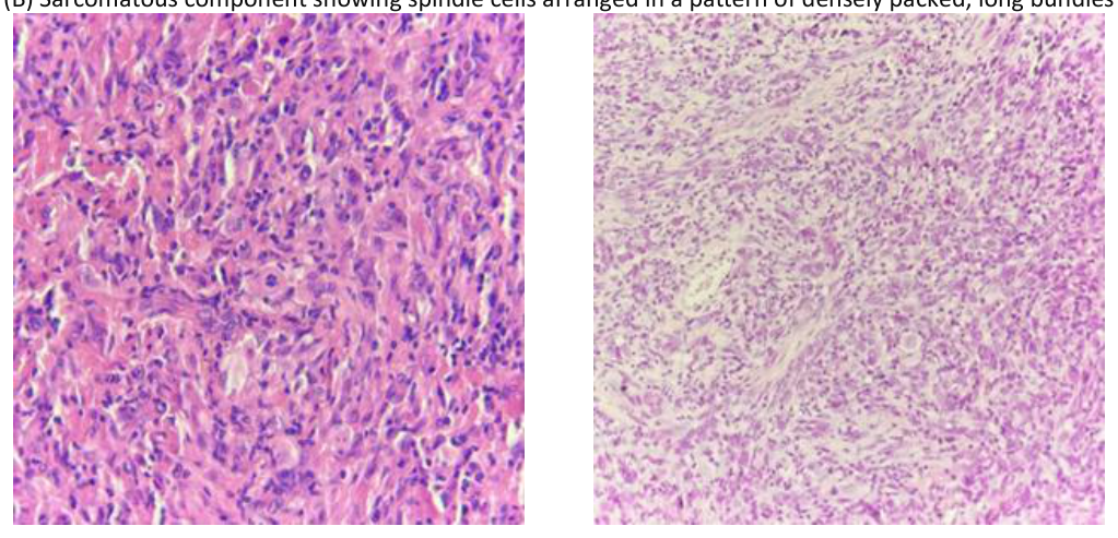 (A) Glial component showing large, pleomorphic, fibrillary astrocytic cells with atypical mitosis in the center. (B) Sarcomatous component showing spindle cells arranged in a pattern of densely packed, long bundles