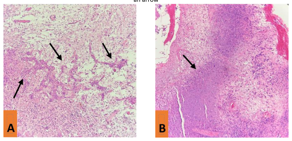 (A) Microvascular proliferation represented by multilayered, small-caliber blood vessels with a glomeruloid appearance. (B) Geographic necrosis with pseudopalisading neoplastic cells surrounding a central area of tumor necrosis