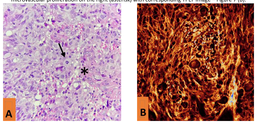 (A) Light microscopy image of large, highly pleomorphic glial cells, with bizarre nuclei, mitotic activity in the center, and microvascular proliferation, with (B) the corresponding TPEF image