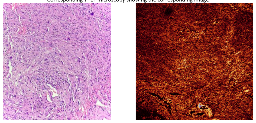 (A) Light microscopy image showing a biphasic pattern, represented by atypical glial cells intermingled with spindle, sarcomatous cells. (B) Corresponding TPEF microscopy image