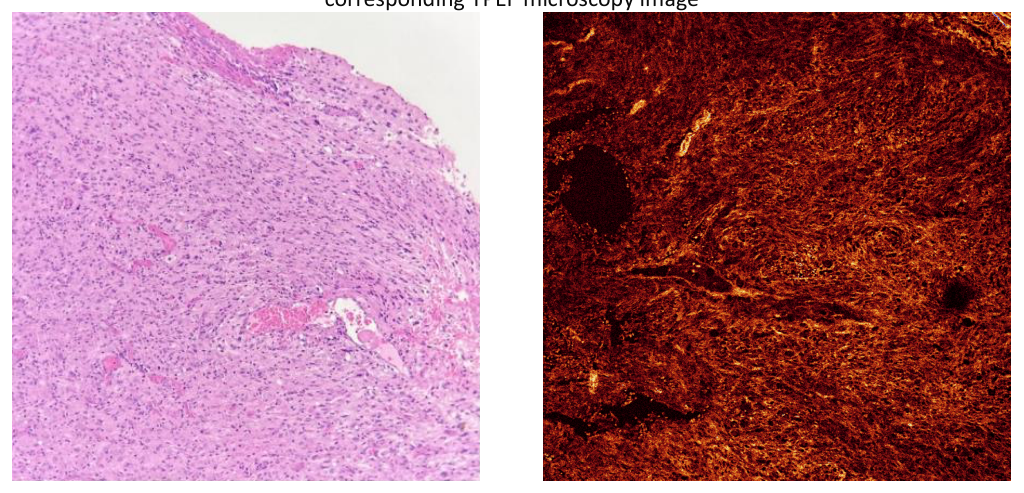 (A) Light microscopy image showing a vessel-rich, fibrosarcomatous area of the tumor, composed of spindle cells, with (B) the corresponding TPEF microscopy image
