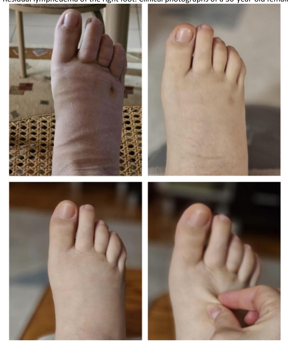 Clinical photographs of the right foot of a 36-year-old female patient before and after bioengineered enzymatic cocktail injections, showing reduced swelling of the toes and forefoot at one month and results maintained at six months