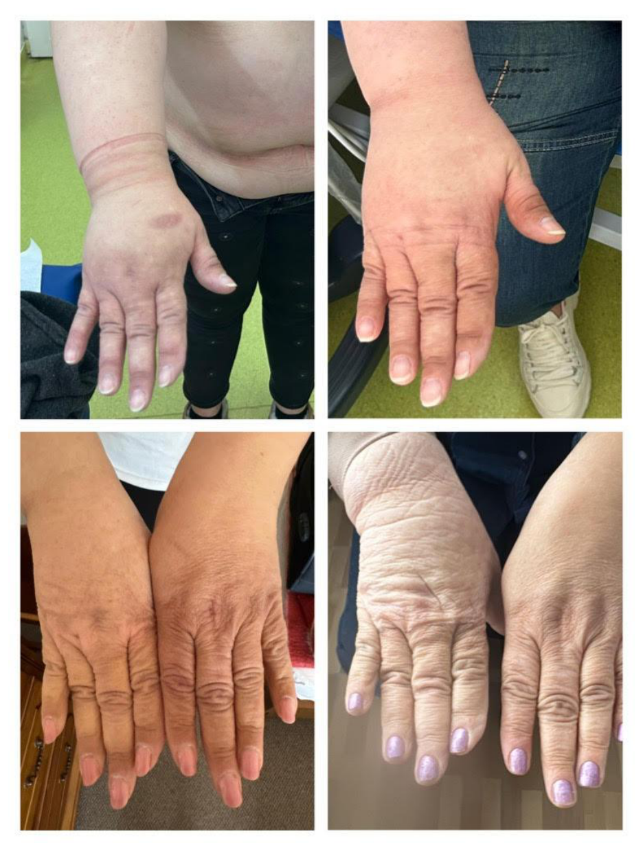 Clinical photographs of the right hand and fingers of a 57-year-old female patient with post-mastectomy lymphedema before and after debulking and bioengineered enzymatic cocktail treatment, showing reduced dorsum and finger swelling at one and six months