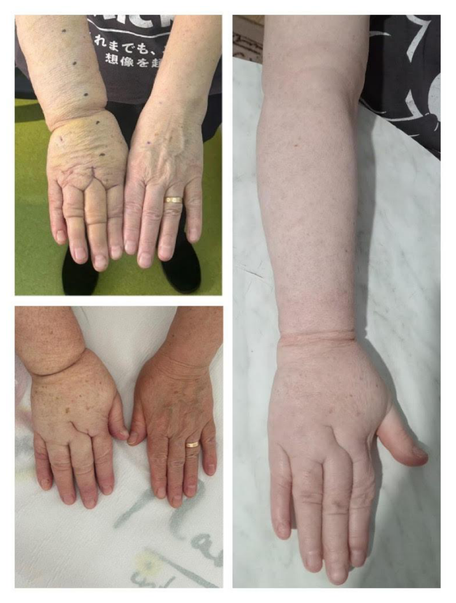Clinical photographs of the right hand and fingers of a 62-year-old female patient with post-mastectomy lymphedema before and after bioengineered enzymatic cocktail treatment, showing decreased finger swelling and creases at one and six months
