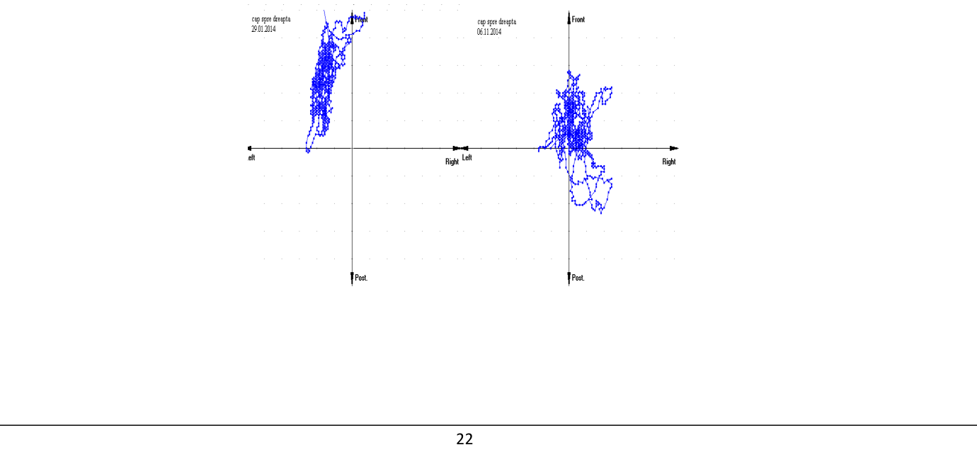 The improvement of the migration of GCG in the position of stand-up face to the right side