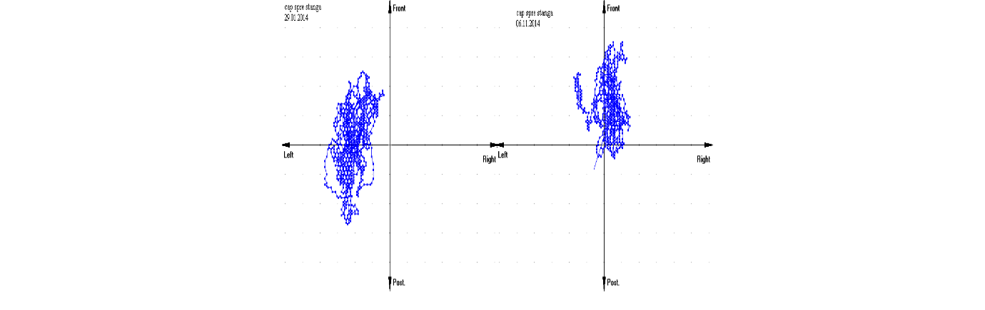 The improvement of the migration of GCG in the position of stand-up face to the left side