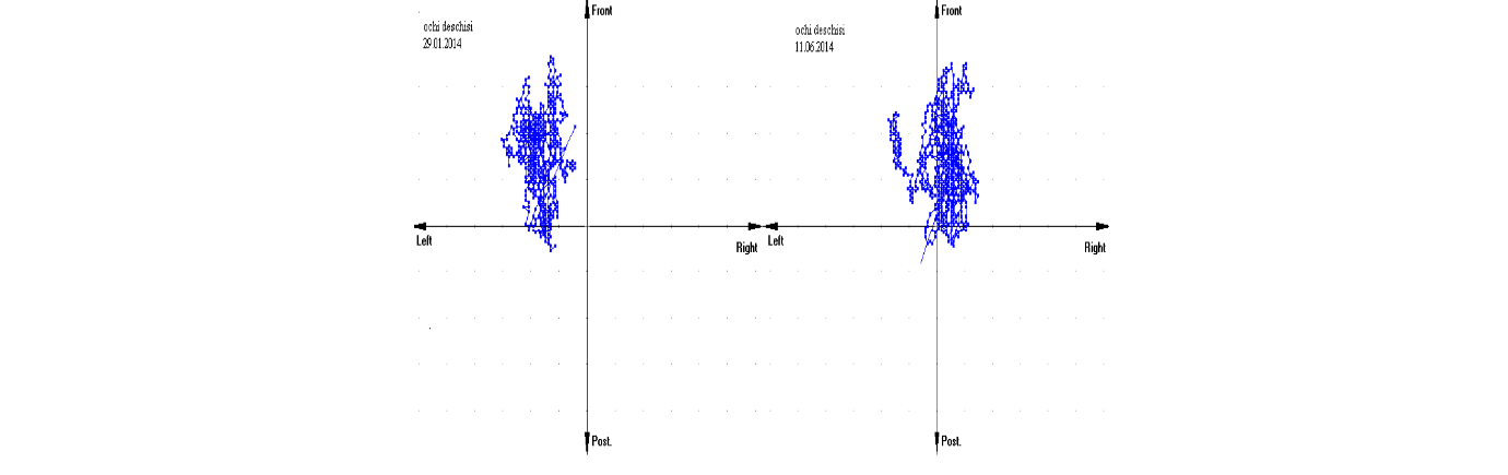 The improvement of the migration of GCG in the position of stand-up eyes closed