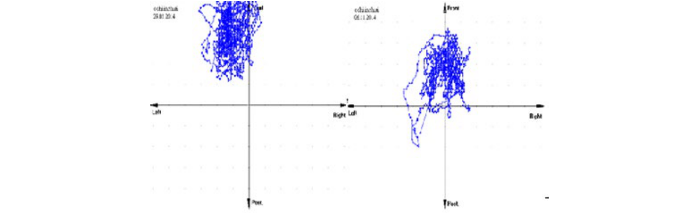 The migration of GCG improved in the position of standing up and eyes open