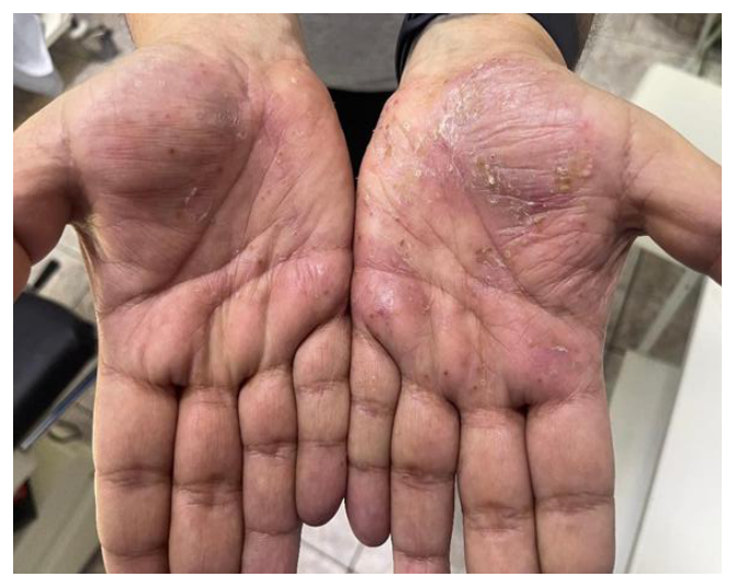 Photograph of both palms showing well-demarcated erythematous plaques with superficial sterile pustules