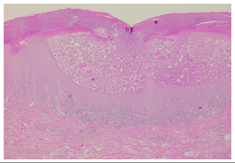 Histopathology slide, H&E stain, showing regular acanthosis, elongation of rete ridges and neutrophilic microabscesses