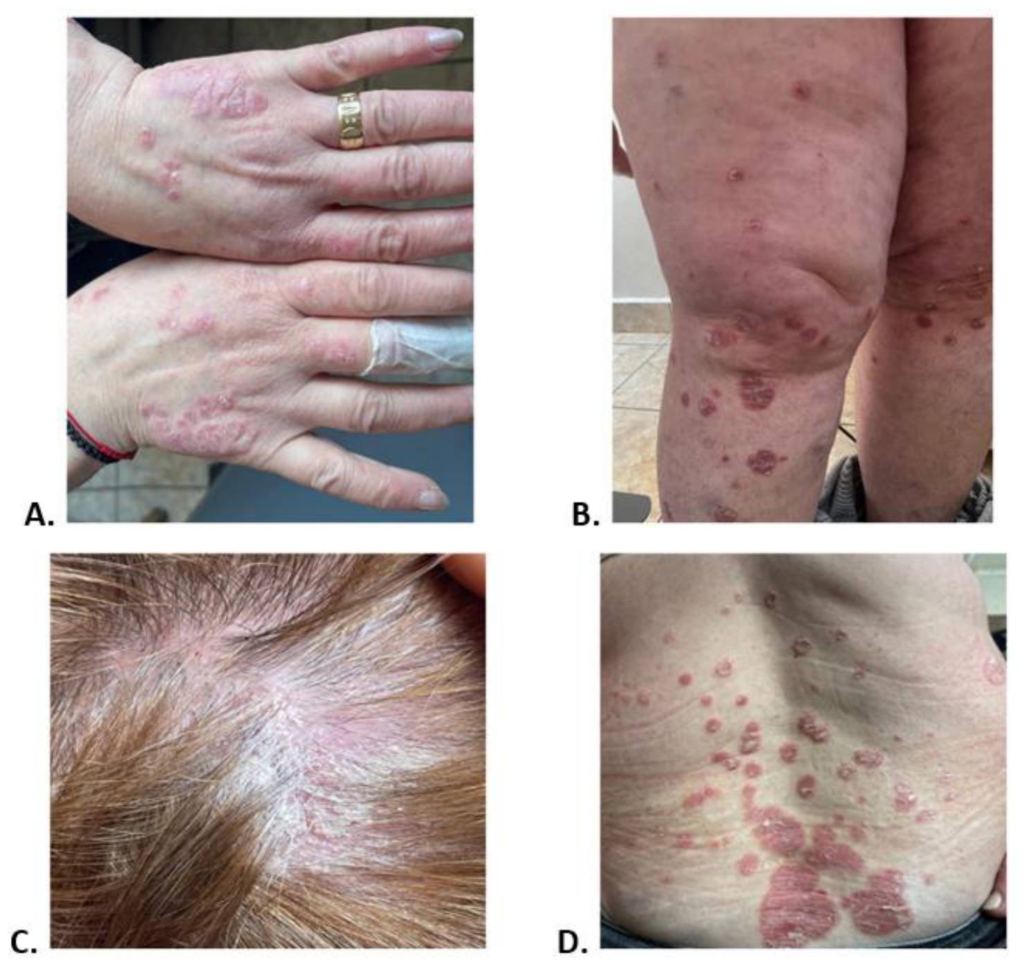 Four clinical photographs (A–D) of erythematous scaly psoriasis plaques on hands, forearms, trunk, scalp and lower limbs