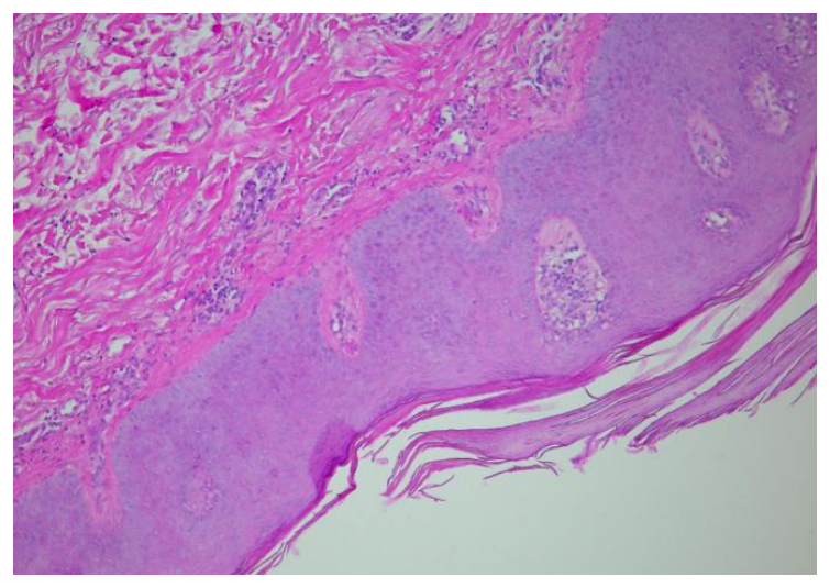 Histopathology slide, H&E stain, showing regular epidermal hyperplasia and superficial dermal inflammatory infiltrate