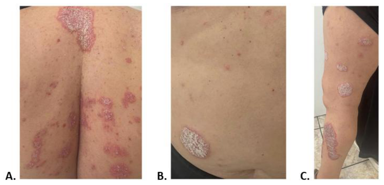 Three clinical photographs (A–C) of erythematous scaly psoriasis plaques on the posterior thorax, abdomen and lower limb