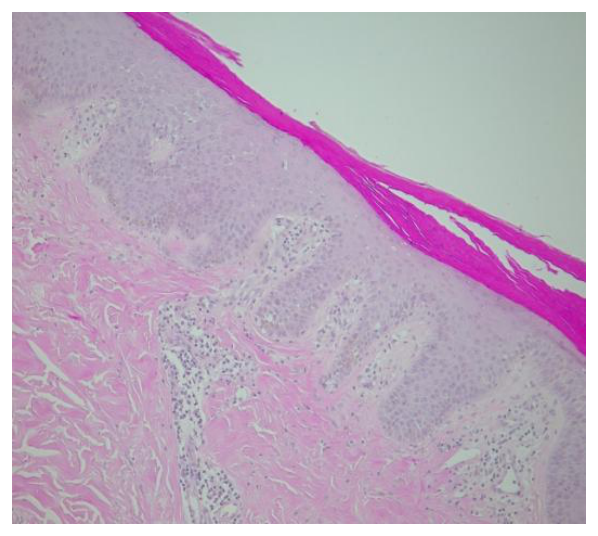 Histopathology slide, H&E stain, showing acanthosis, hyperkeratosis and neutrophilic aggregates (Munro microabscesses)