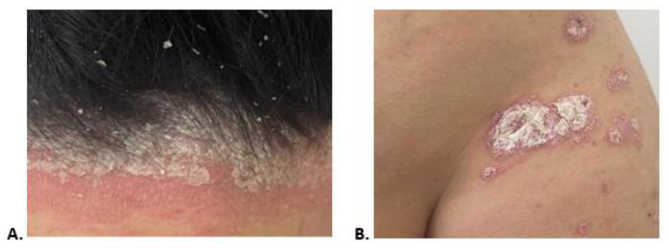 Two clinical photographs (A–B) of erythematous scaly psoriasis plaques on the scalp and extensor surface