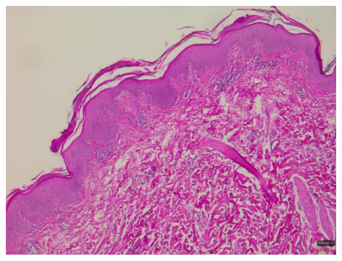 Histopathology slide, H&E stain, showing marked acanthosis, hyperkeratosis and dilated dermal capillaries