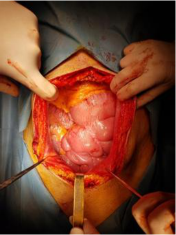 Abdominal adhesions