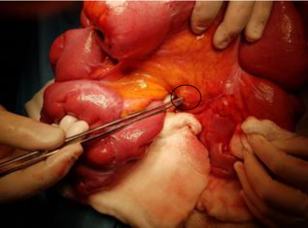 Mesenteric tumoral mass