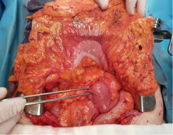Side-to-side anastomosis