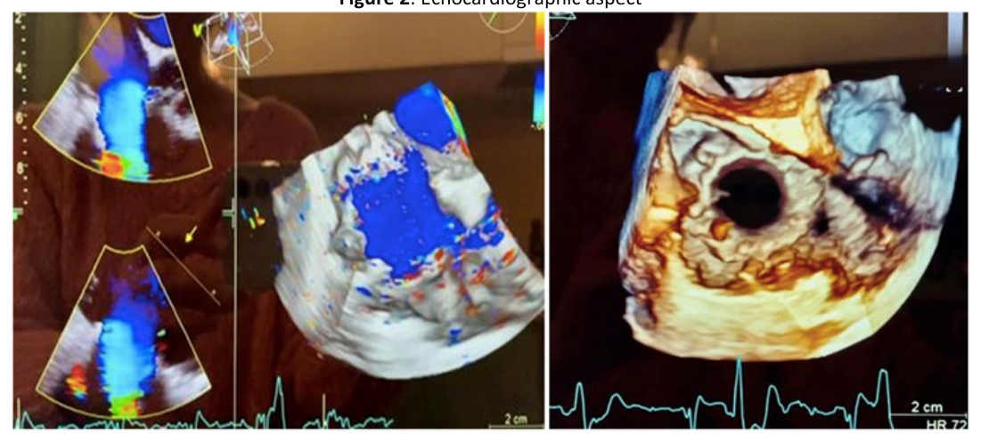 Aspect ecocardiografic postprocedural cu evaluare Doppler color și reconstrucție tridimensională a valvei